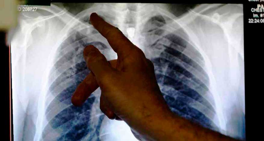 OMS: nuevo tratamiento oral contra la tuberculosis
