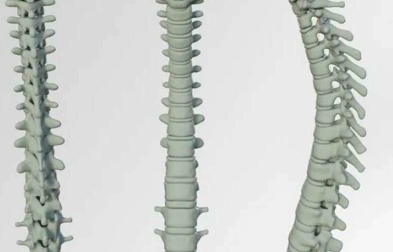 El dolor lumbar crónico, una condición incapacitante para 10 millones de personas