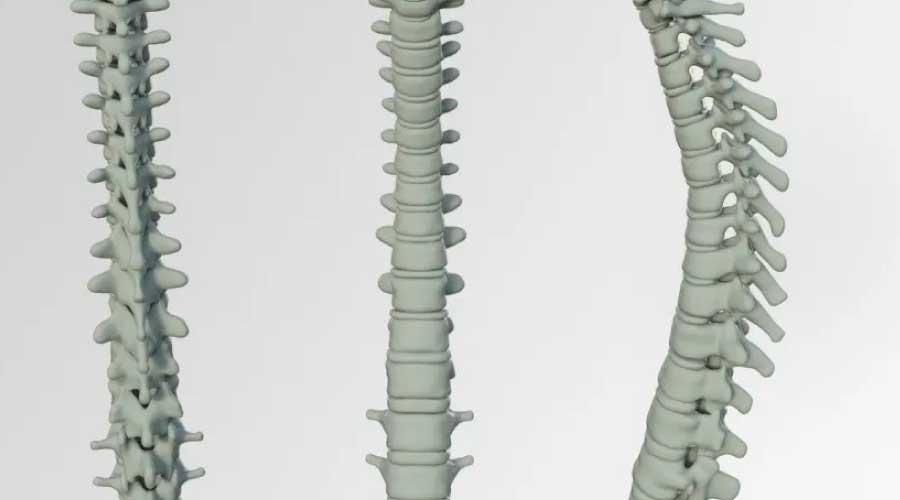 El dolor lumbar crónico, una condición incapacitante para 10 millones de personas